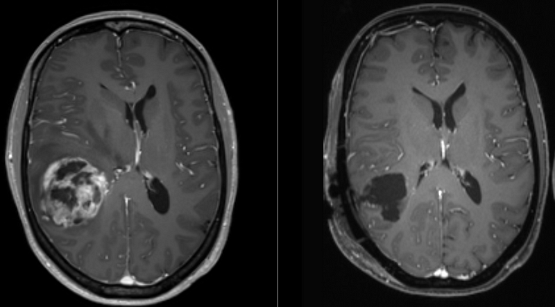 Glioblastoma tumor imaging